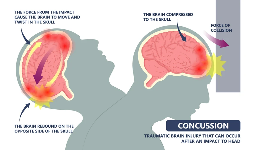 Concussion graphic 1