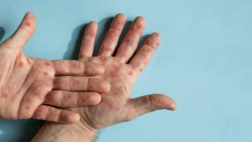 Viral pox rash on hands